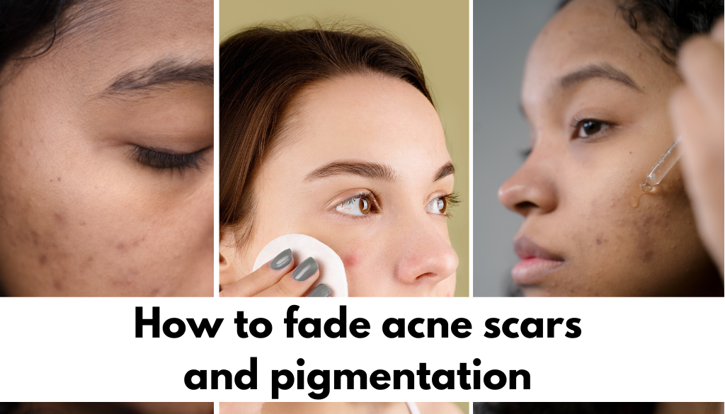 fade acne scars and pigmentation