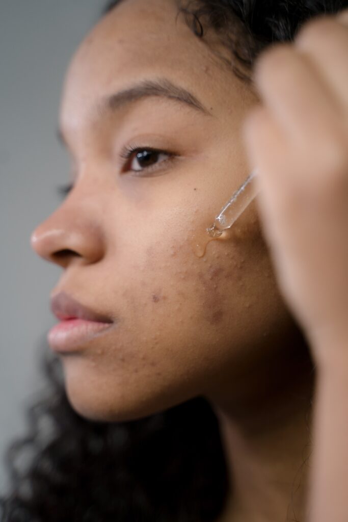 fade acne scars and pigmentation